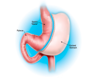 gastric sleeve hickory