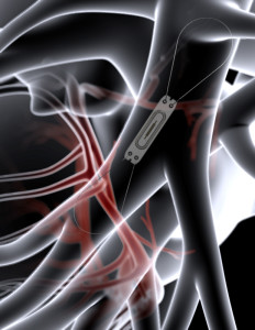Image provided courtesy of St. Jude Medical, Inc.